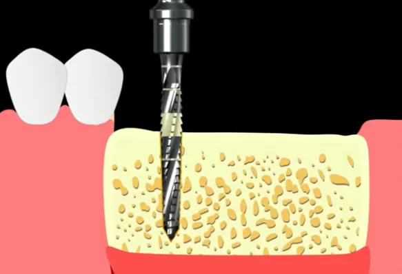 Bone penetration to a depth of 11 mm according to drill marking