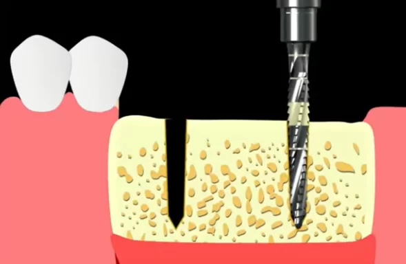 Primary passage for the second implant bed