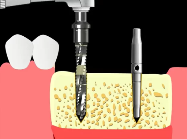 Drill through the hole with a 2. 6 mm drill bit without removing the parallelism pin from the second hole