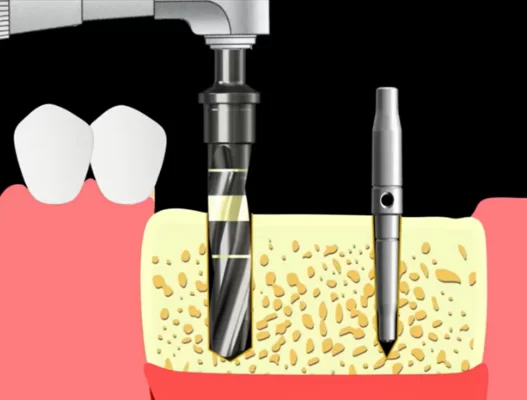 Dilatation of the implant hole with a 4. 0 mm drill bit