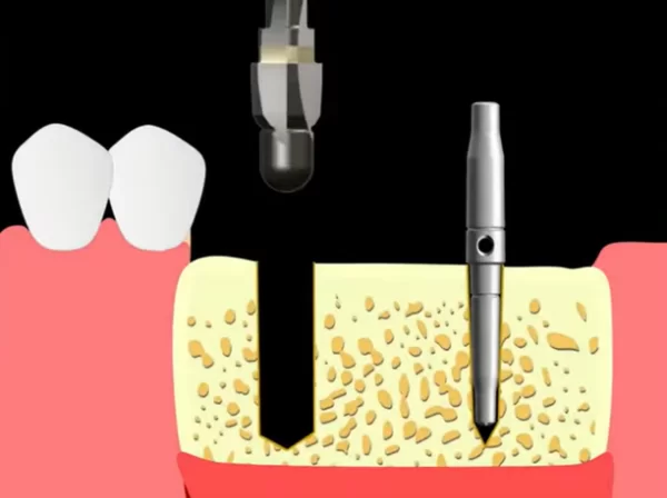 Widening of the implant bed for normal tapered implant placement