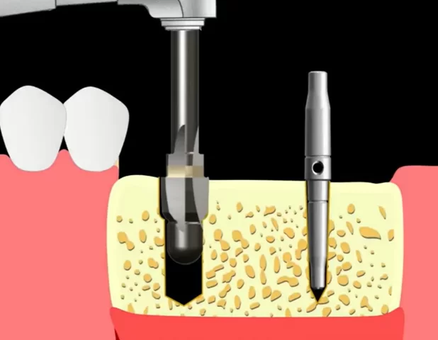 Widening of the implant bed for normal tapered implant placement