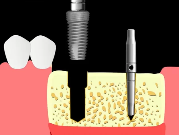 Prepared implant bed