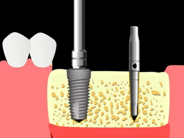 Mechanical insertion of the implant into the hole