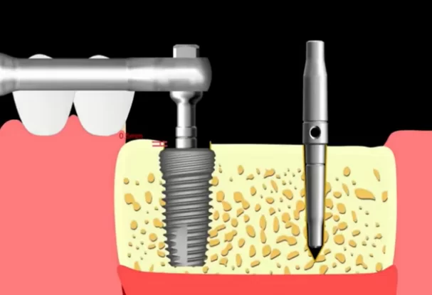 Subcrestal implant placement