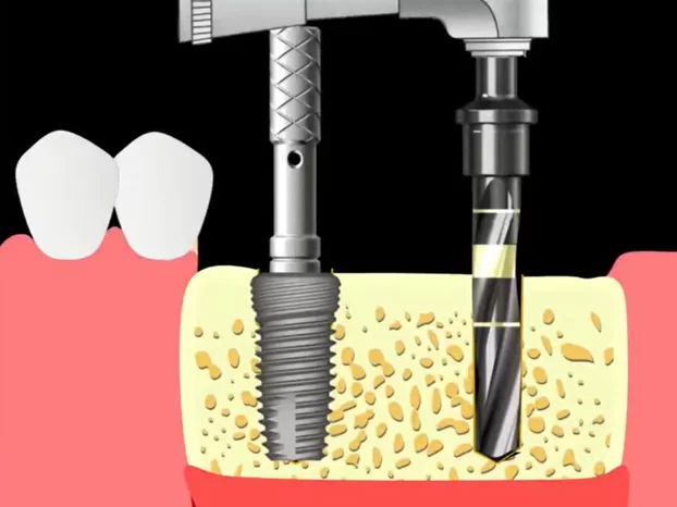 Preparing the bed and placing the second implant guided by the pin placed in the first implant