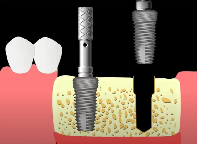 Preparing the bed and placing the second implant guided by the pin placed in the first implant