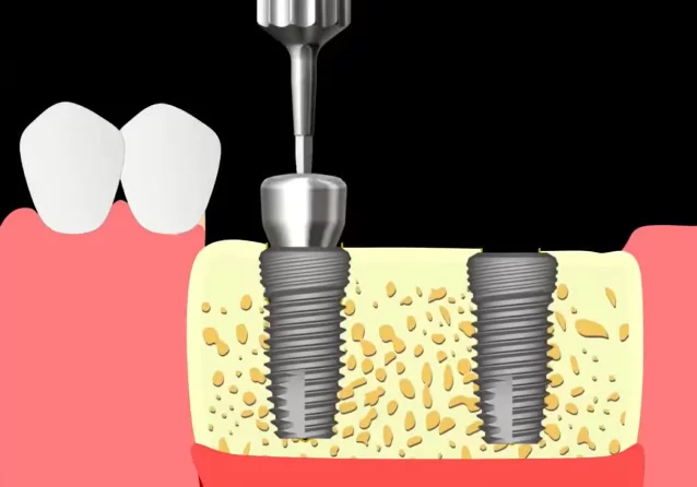 Placement of gingival formers and suturing of the flap along the contour