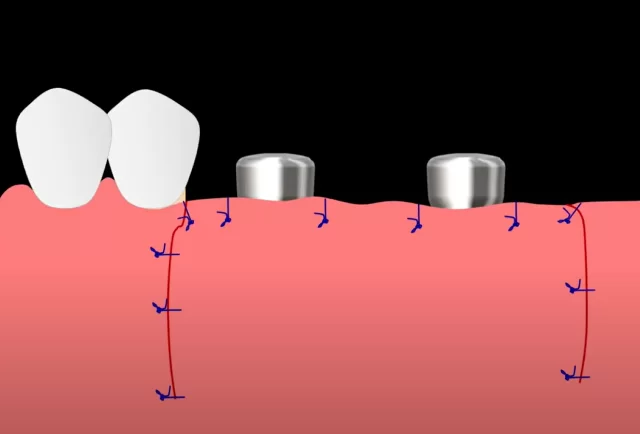 Placement of gingival formers and suturing of the flap along the contour