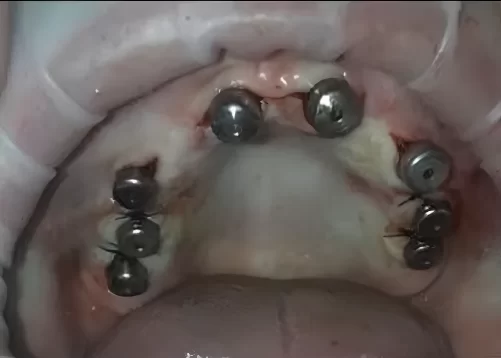 Placement of gingival shapers in a patient with a thick (fortunate) biotype