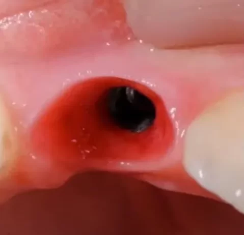 Well-formed gingiva with pronounced papillae in the aesthetic zone is ready for crown placement