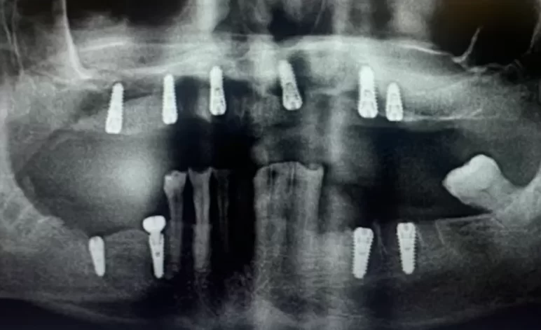 Orthopantomogram with implant placement