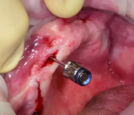 Screwdriver for removing covers from the implant