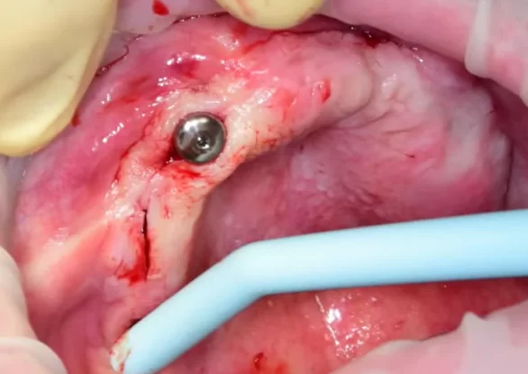 Installed gingival shaper tightly surrounded by soft tissues