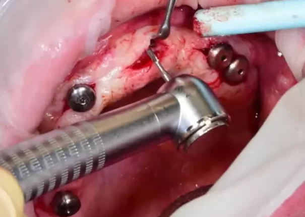 Bone removal to release the implant interface and cover