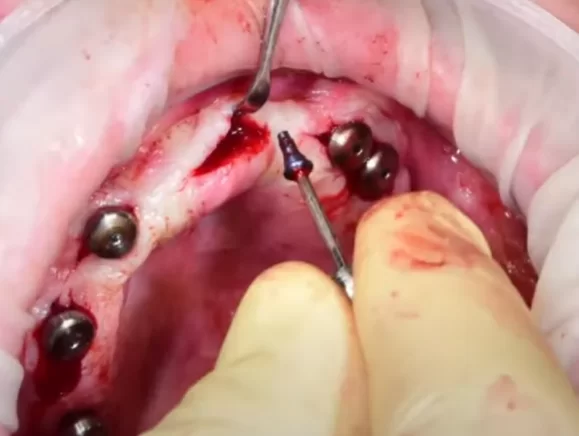 Removal of the implant cover