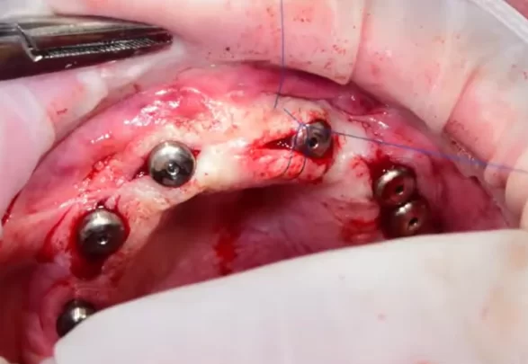 Placement of a gingival shaper and suturing of the incision