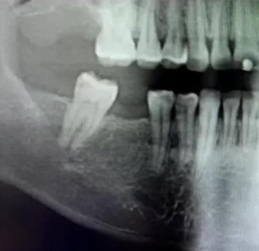 Image of the bone condition before implantation at the position of the 46th tooth