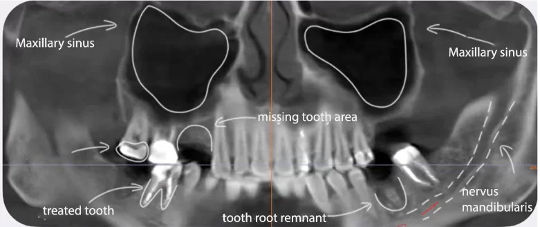 Ct scan of the patient's dental condition