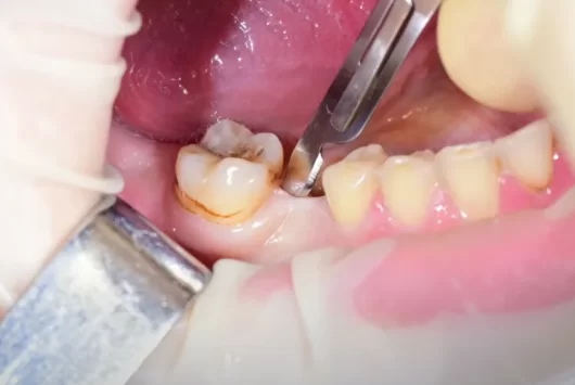 Soft tissue incision for subsequent flap detachment