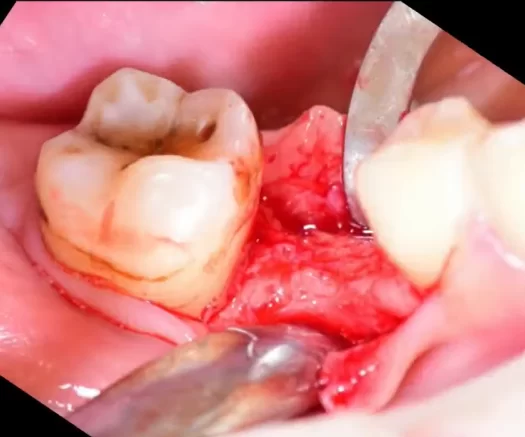 Open bone ridge for implant placement