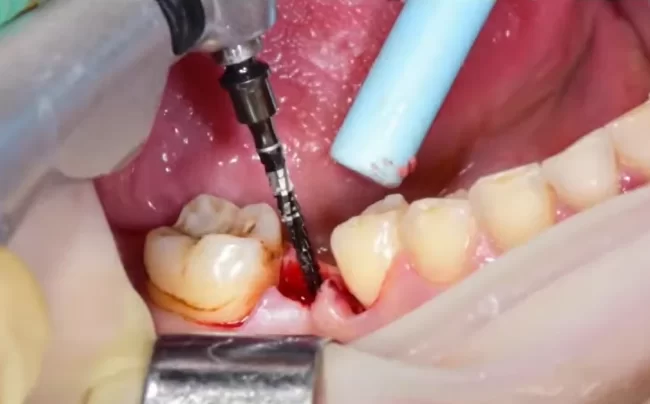 Start drilling the implant hole with the lindemann drill