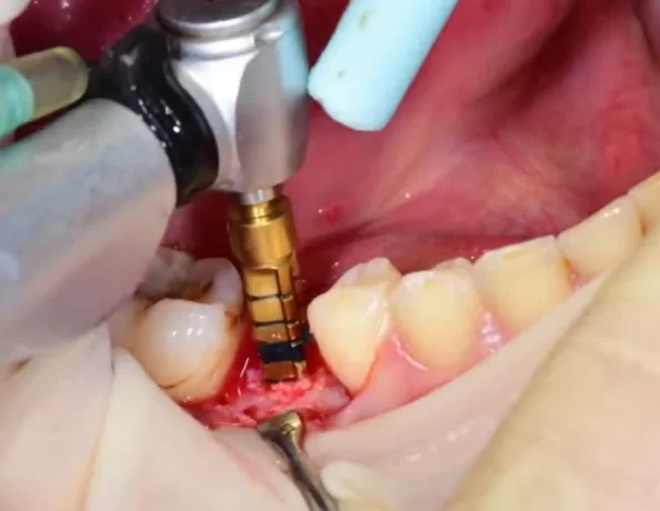 Expansion of the implant bed with a 3. 8 mm drill