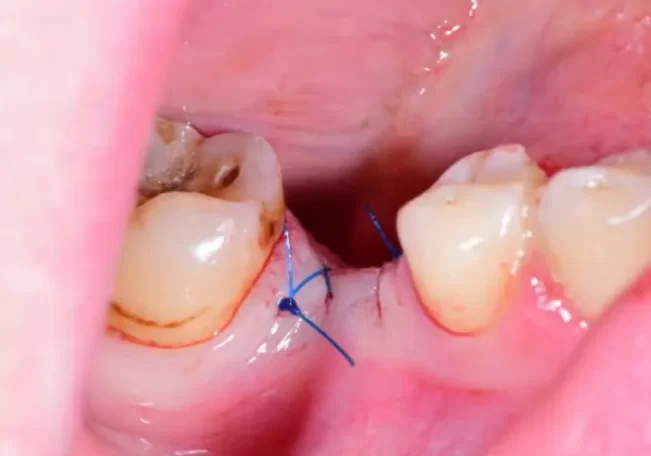 Soft tissue sutures over the placed implant