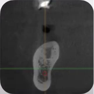 Coronal slice – here you can see the bone density, width, and shape of the bone ridge