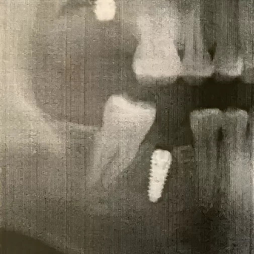 Control image of the placed implant