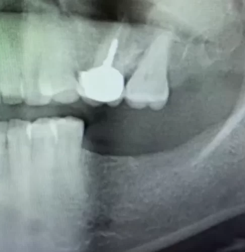 Image of the initial state of the mandibular bone and the location of the antagonist teeth