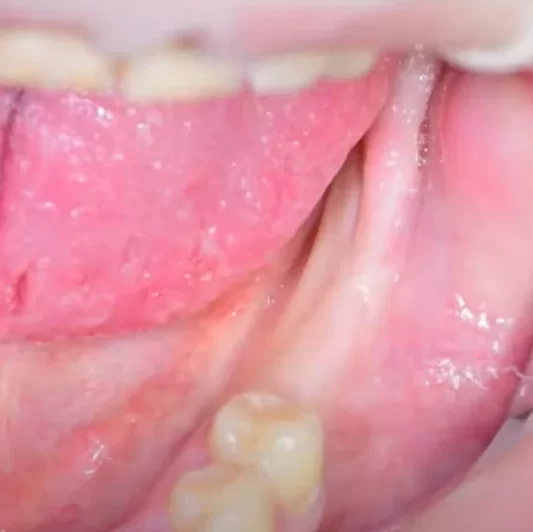 Image of the initial soft tissue condition before the implant placement surgery