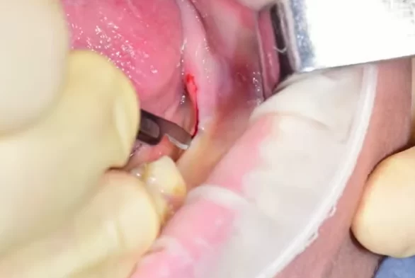 Soft tissue incision before implant placement