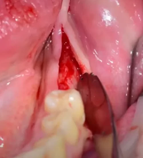 Flap detachment from the bone before implant placement