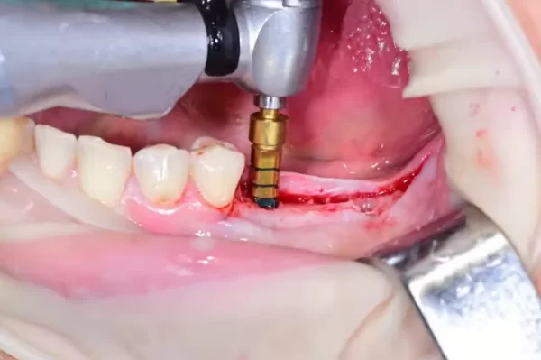 Widening of the hole with 3. 3 and 3. 8 mm drills with simultaneous correction of the angle defect