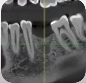 Sagittal slice – here you can see the neighboring teeth and antagonist teeth