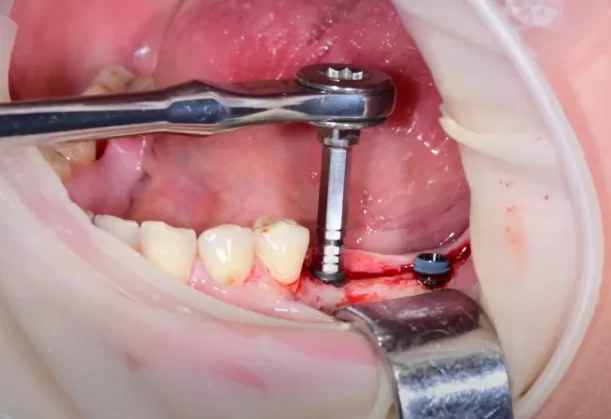 Adjusting the implant to the desired seating depth with a torque wrench