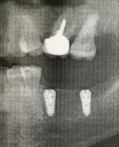 Control image after implant placement in tooth positions 36 and 37