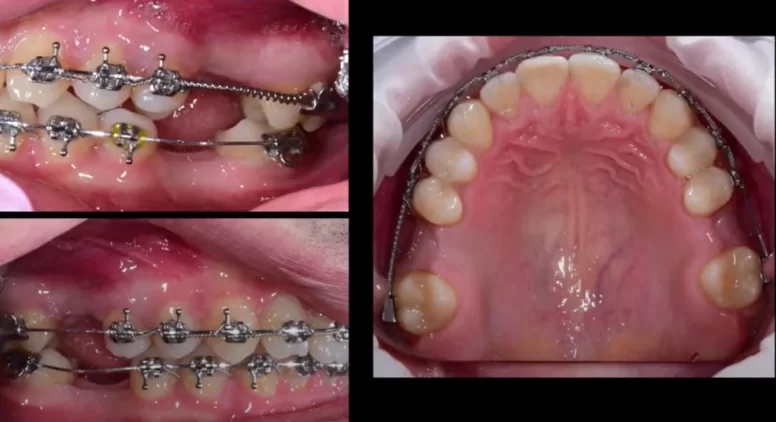 Initial situation patient with braces