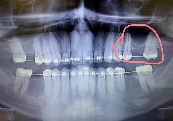 Orthopantomogram of the initial clinical picture