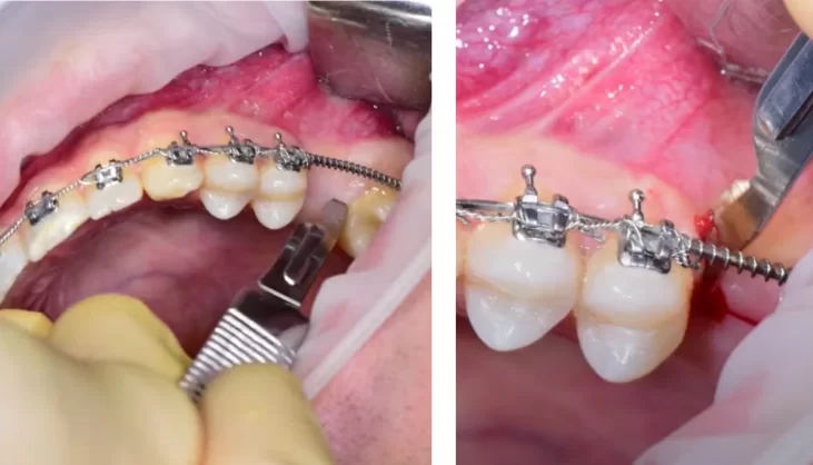 Incision to preserve gingival volume after implant placement and open sinus lift surgery