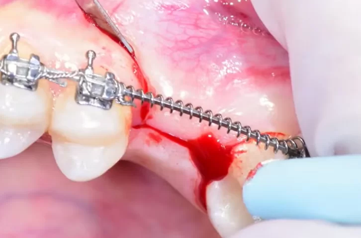 Incision to preserve gingival volume after implant placement and open sinus lift surgery