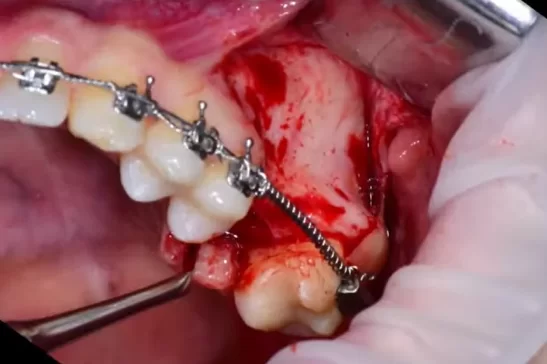 Flap detachment for bone access