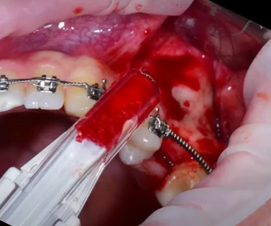 Removal of the cortical layer to access the schneiderian membrane with a disposable scraper