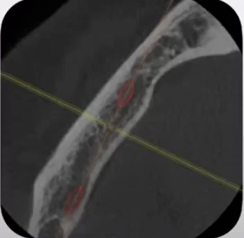 Axial slice – here you can see the location of the mandibular nerve