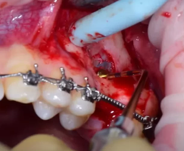 Detachment of the schneiderian membrane from the cortical layer of the alveolar socket of the maxillary sinus