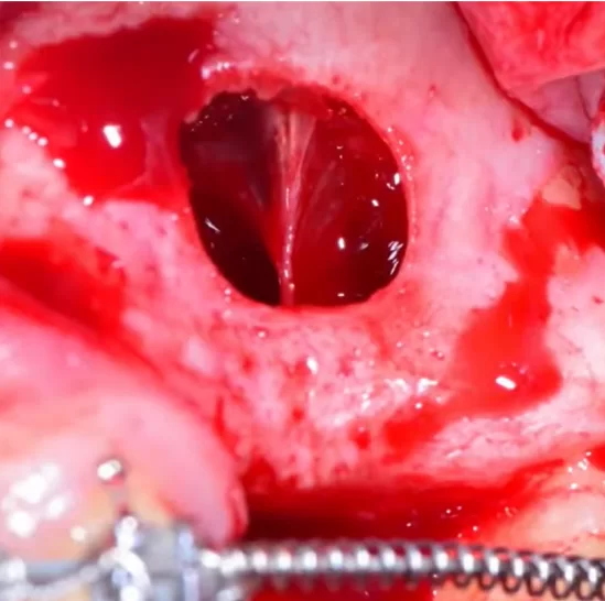 Schneiderian membrane has an adnation in the area of the extracted tooth