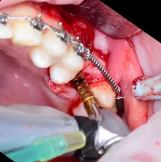 Expansion of the implant bed with a 3. 3 mm drill bit