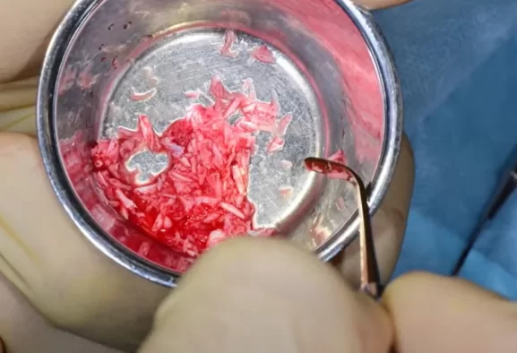 Preparation of bone material for open sinus lift surgery