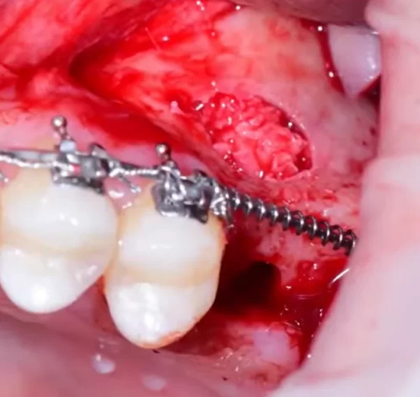 Bone material in the alveolar cove of the maxillary sinus beneath the schneiderian membrane